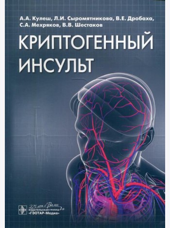 Криптогенный инсульт: руководство