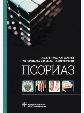 Псориаз