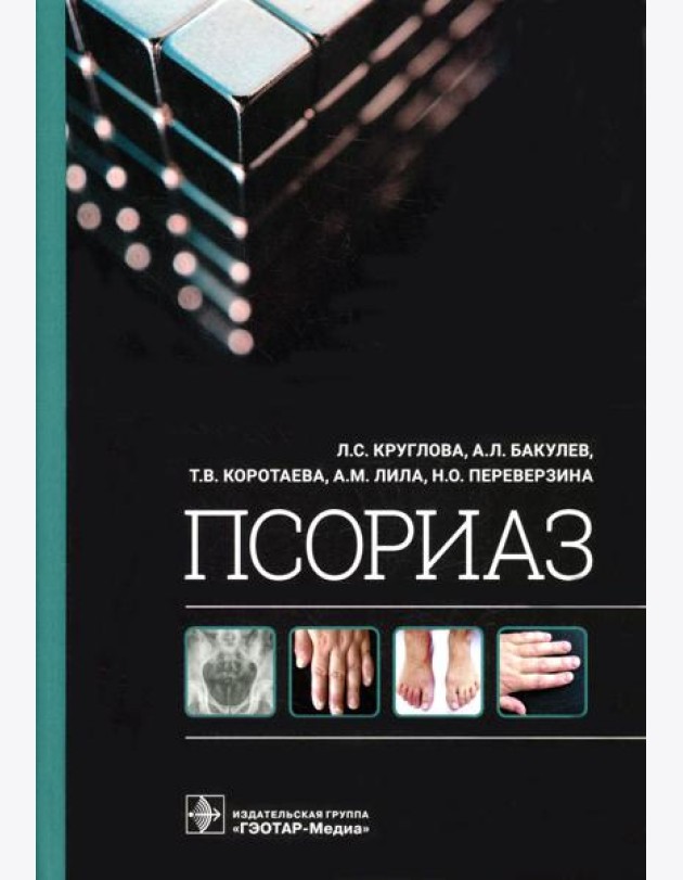 Псориаз