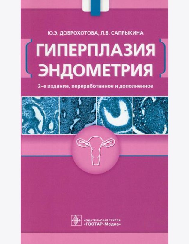Гиперплазия эндометрия