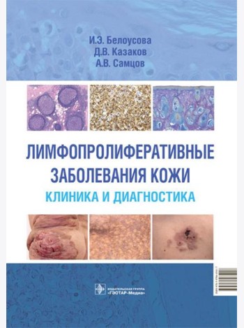 Лимфопролиферативные заболевания кожи. Клиника и диагностика