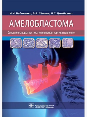 Амелобластома: современная диагностика, клиническая картина и лечение