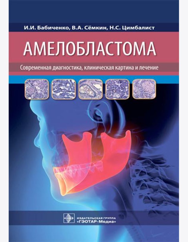 Амелобластома: современная диагностика, клиническая картина и лечение