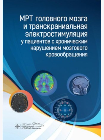 МРТ головного мозга и транскраниальная электростимуляция у пациентов с хроническим нарушением мозгового кровообращения