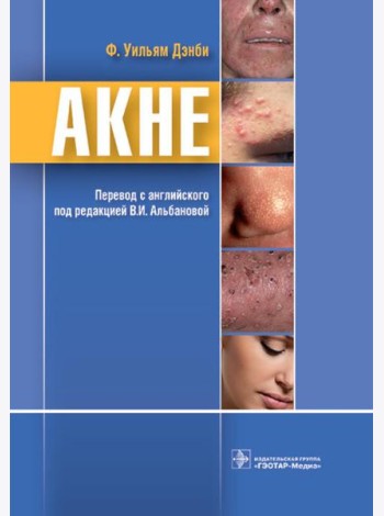 Акне