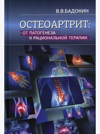 Остеоартрит: от патогенеза к рациональной терапии
