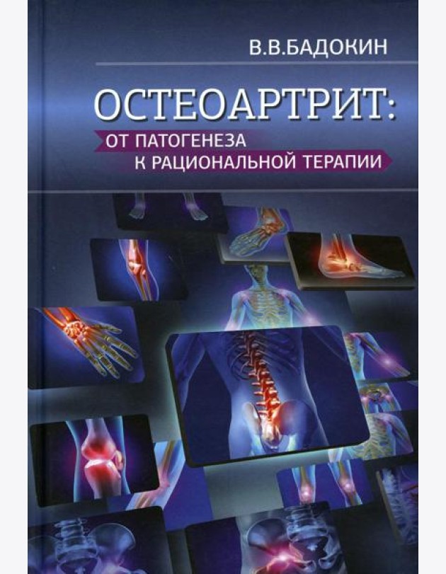 Остеоартрит: от патогенеза к рациональной терапии