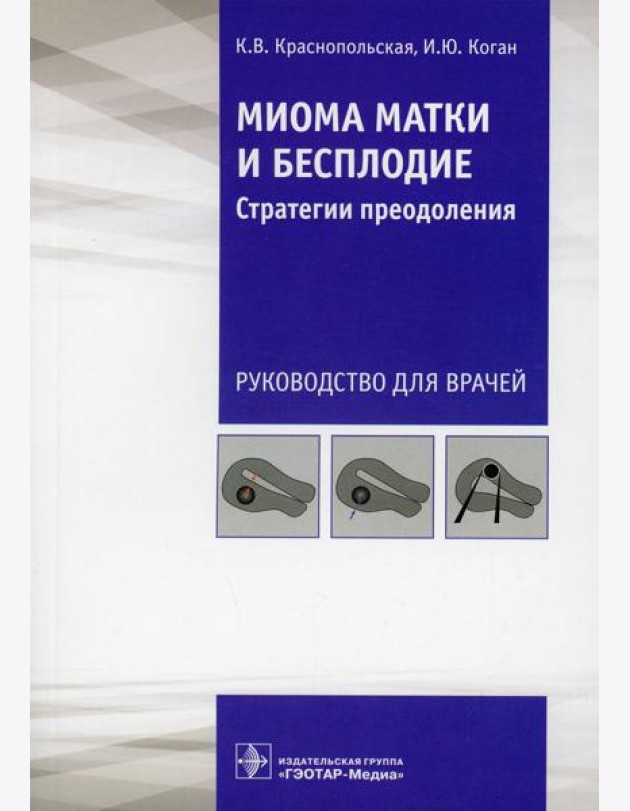 Миома матки и бесплодие: стратегии преодоления: руководство для врачей