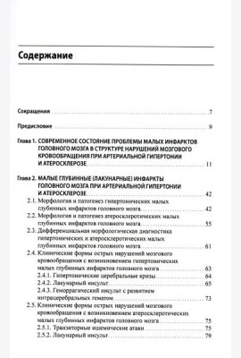 Малые инфаркты головного мозга