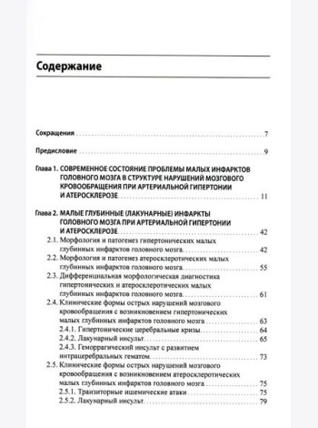 Малые инфаркты головного мозга