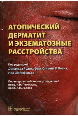 Атопический дерматит и экзематозные расстройства