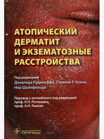 Атопический дерматит и экзематозные расстройства