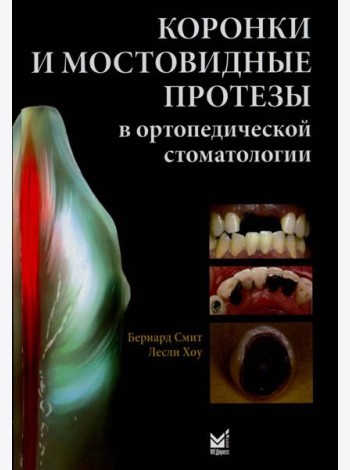 Коронки и мостовидные протезы в ортопедической стоматологии