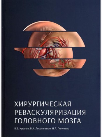 Хирургическая реваскуляризация головного мозга