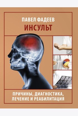 Инсульт. Причины, диагностика, лечение и реабилитация