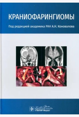 Краниофарингиомы