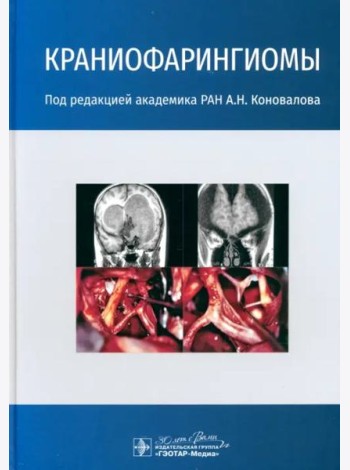 Краниофарингиомы
