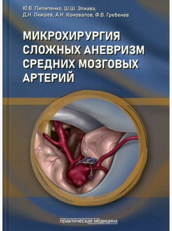 Микрохирургия сложных аневризм средних мозговых артерий: гигантских, фузиформных и частично тромбированных