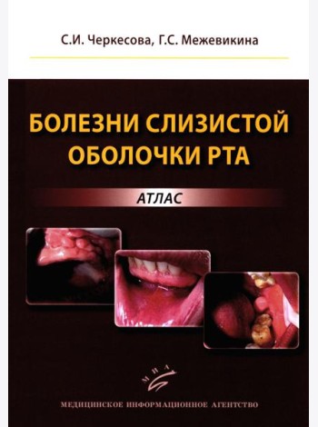 Болезни слизистой оболочки рта: атлас