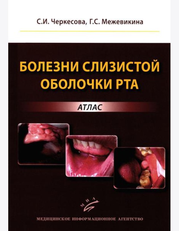 Болезни слизистой оболочки рта: атлас
