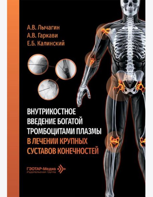 Внутрикостное введение богатой тромбоцитами плазмы в лечении крупных суставов конечностей