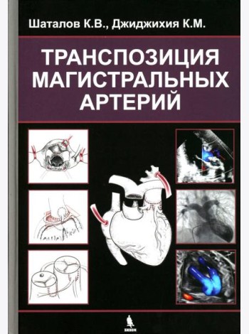 Транспозиция магистральных артерий