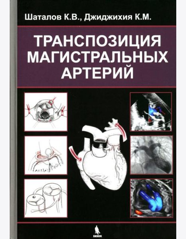 Транспозиция магистральных артерий
