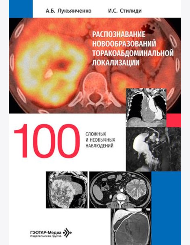 Распознавание новообразований торакоабдоминальной локализации: 100 сложных и необычных наблюдений