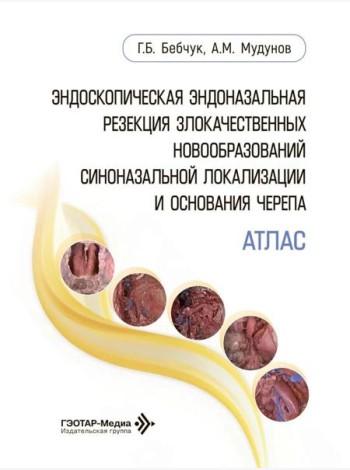 Эндоскопическая эндоназальная резекция злокачественных новообразований синоназальной локализации и основания черепа. Атлас